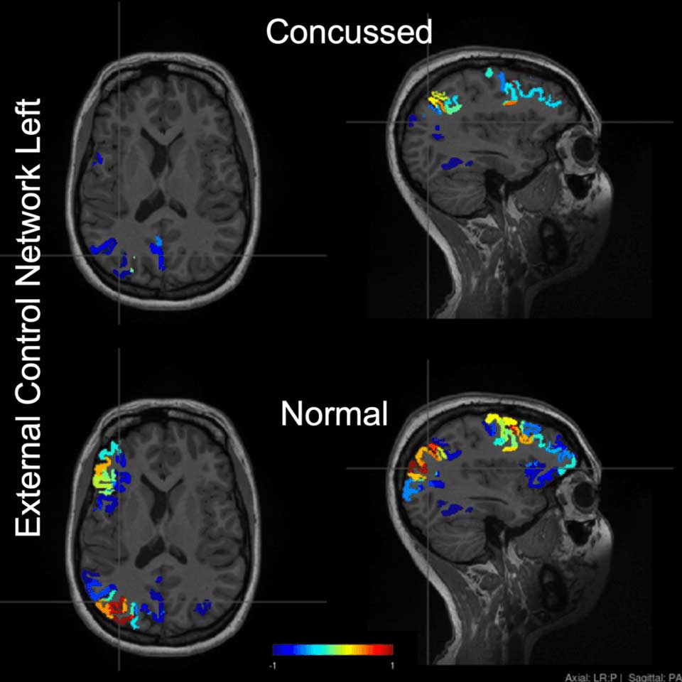 Images of neural network damage in a concussed brain, compared with a baseline MRI of a person without concussion. Images courtesy of Andrea Soddu, Western University
